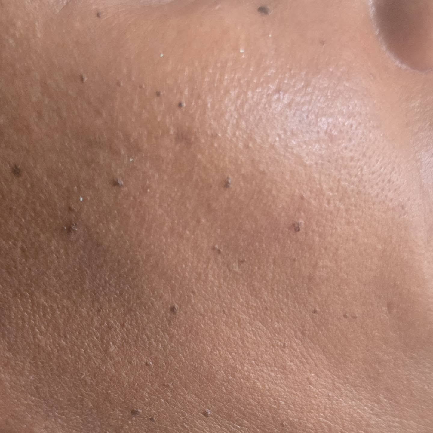 DPN / Mole Removal via Electrocautery – $100 BBD/hr
