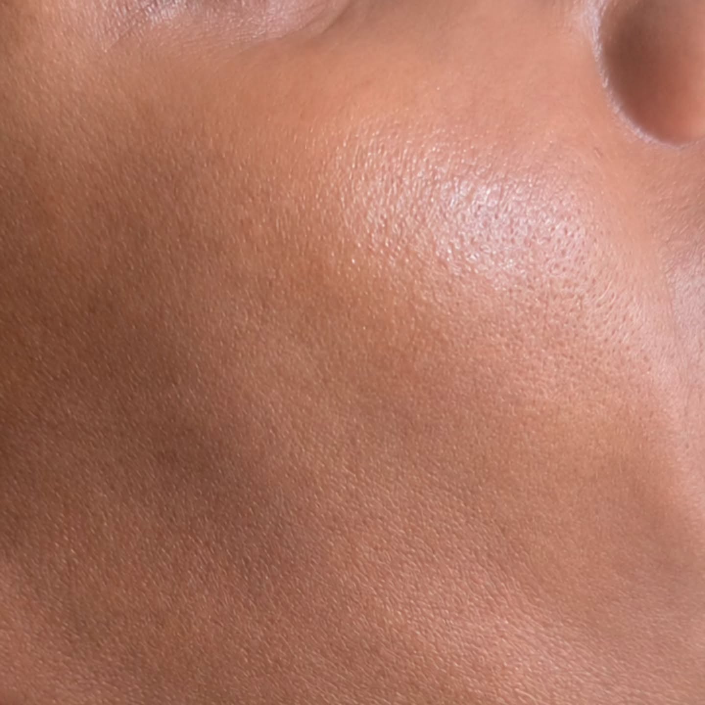 DPN / Mole Removal via Electrocautery – $100 BBD/hr