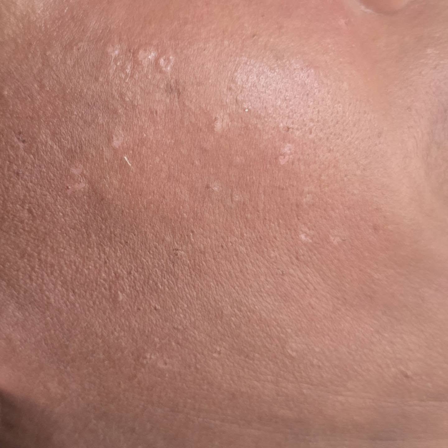 DPN / Mole Removal via Electrocautery – $100 BBD/hr